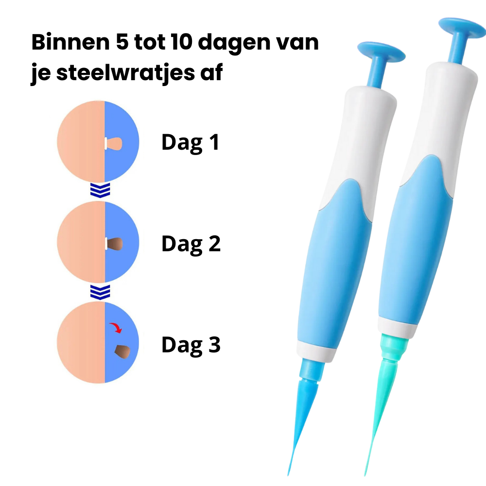 TackPen™ Kit | Verwijder steelwratjes veilig