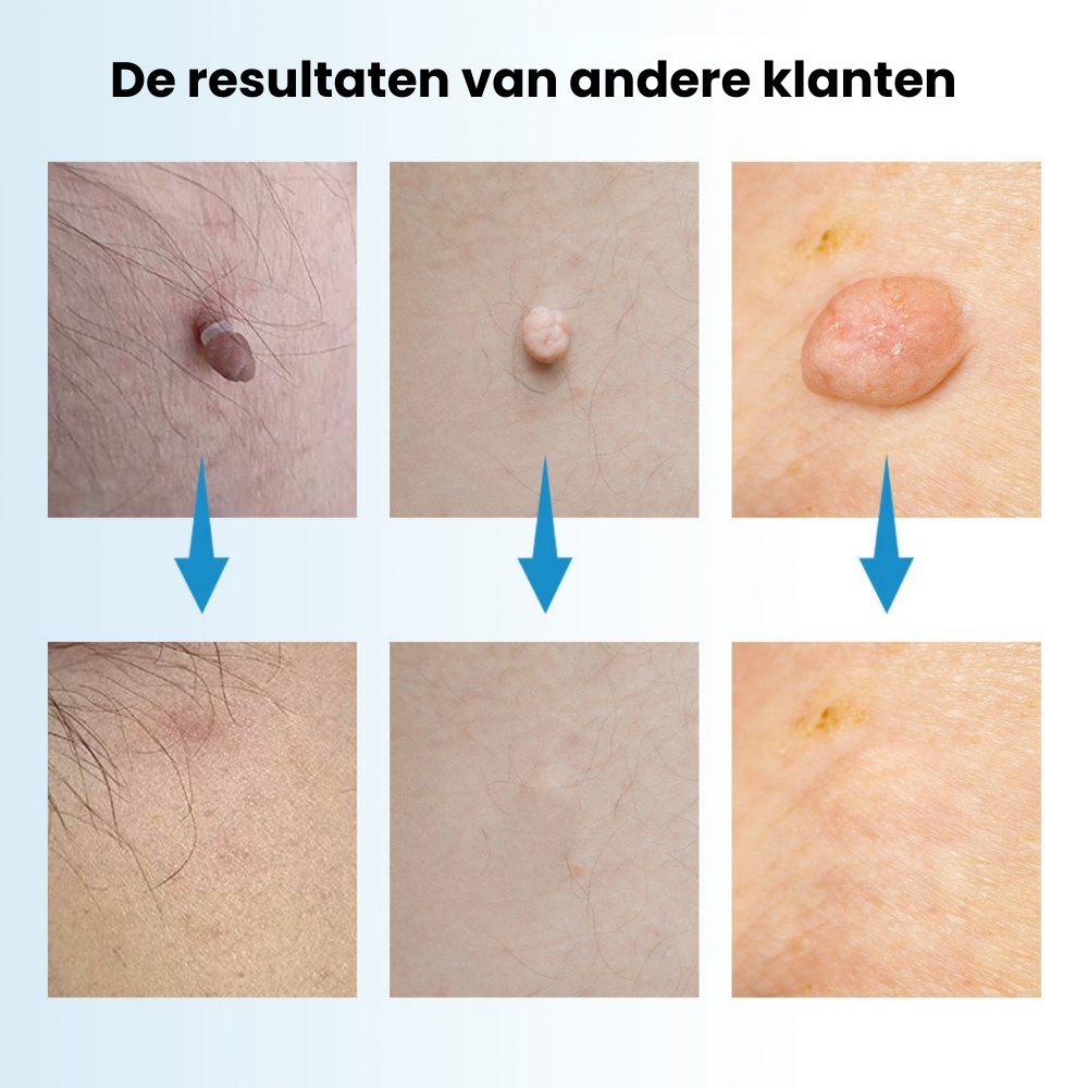 TackPen™ Kit | Verwijder steelwratjes veilig