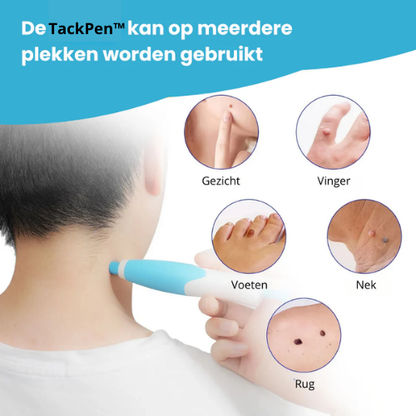 TackPen™ Kit | Verwijder steelwratjes veilig