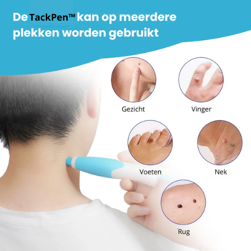 TackPen™ Kit | Verwijder steelwratjes veilig